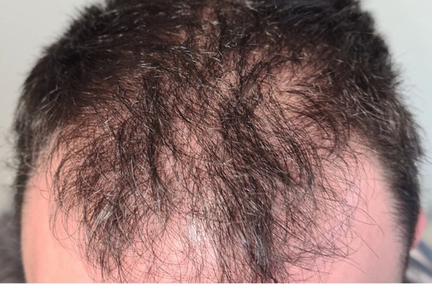 CYJ Hairfiller før og etter