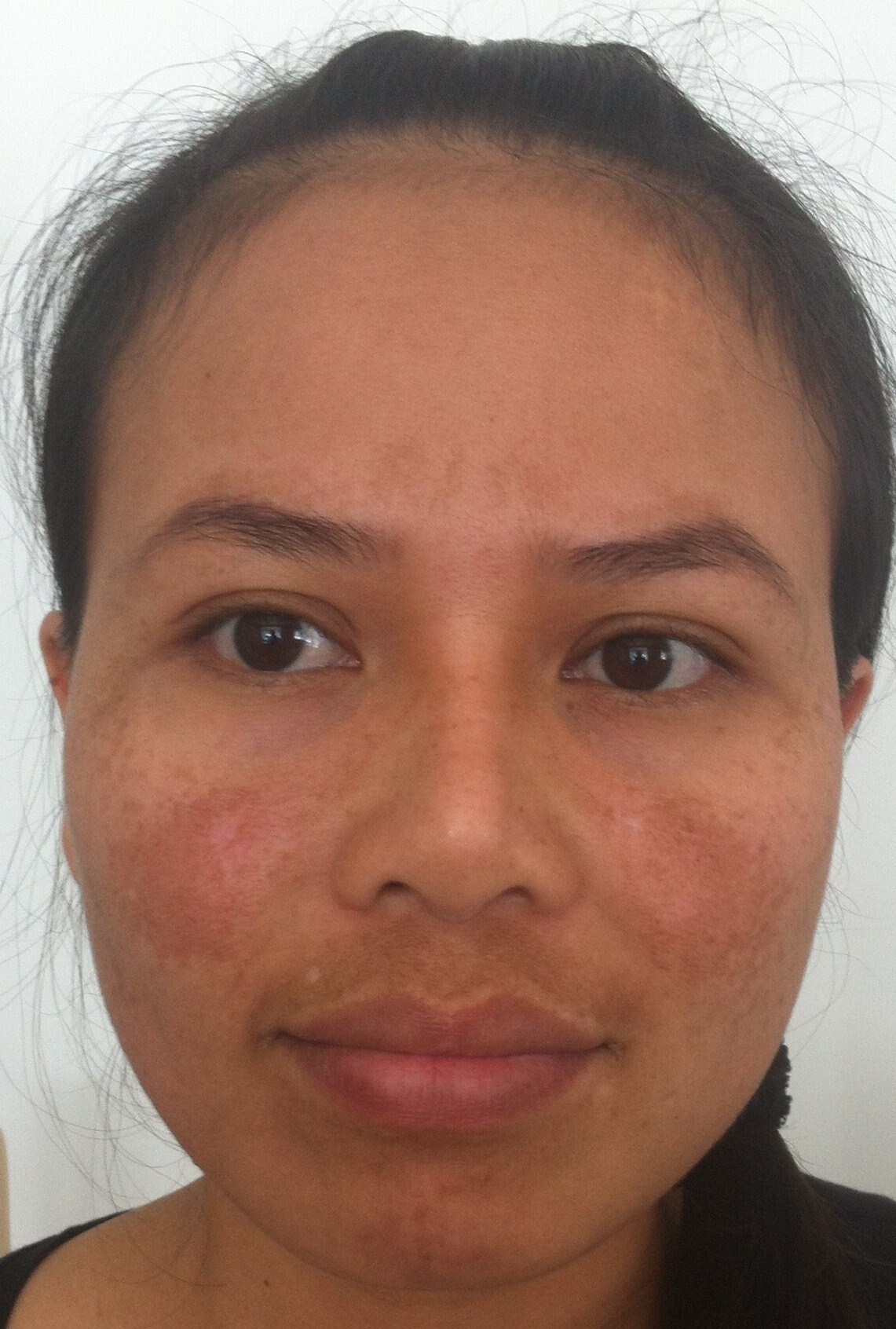 Cosmelan® & Dermamelan® Peel Før og etter
