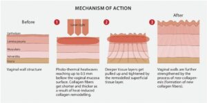 mechanismAction1